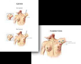 medical legal courtroom illustrations for the LaMonica breast cancer case of Cambrisge, Massachusetts &copy; Laura Maaske
