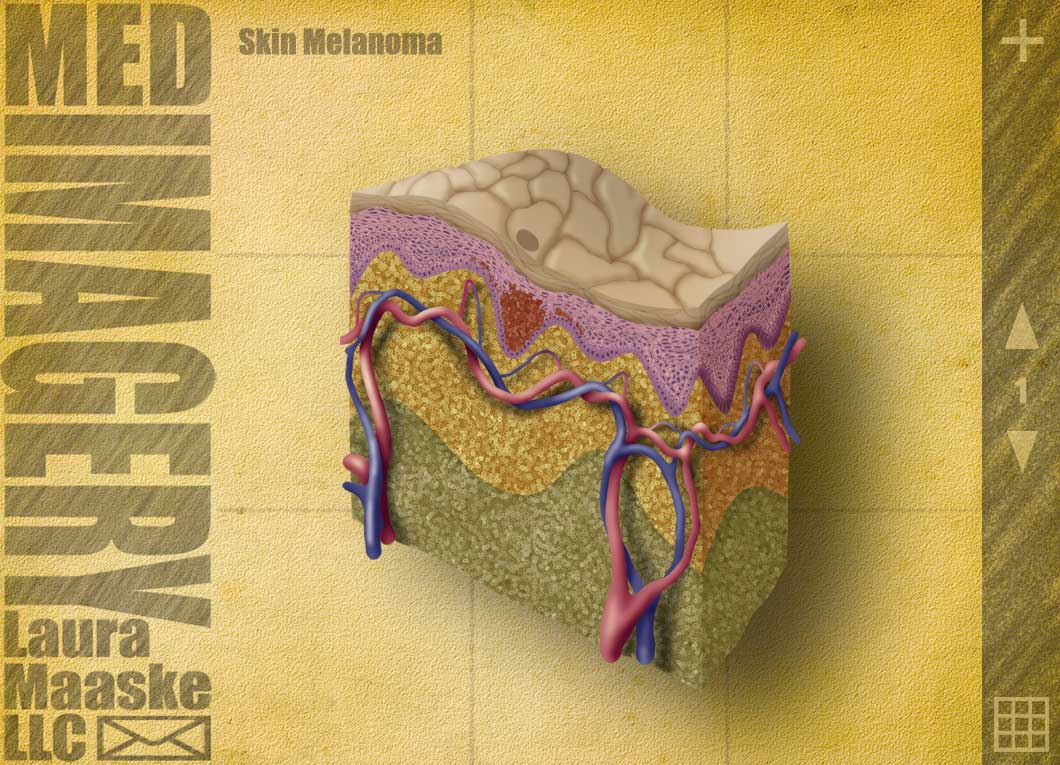melanoma