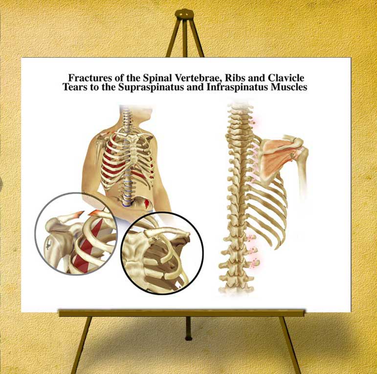 personal_injury_illustration